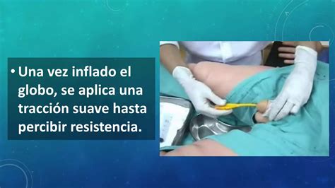 sonda vesical mujer real|Procedimiento de sondaje vesical. Mujeres